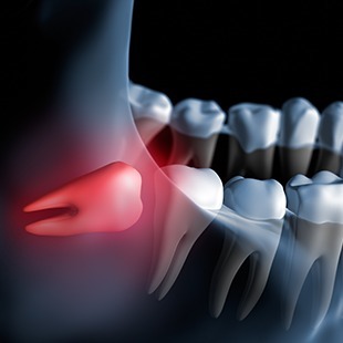 親知らずについて