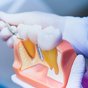 インプラントについて